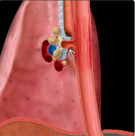 Túi thừa thực quản do kéo (Traction Diverticulum)