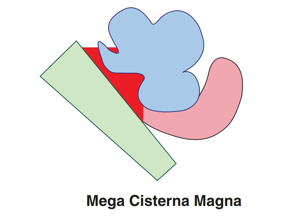 Giãn bể lớn hố sau ở thai nhi (Mega Cisterna Magna)