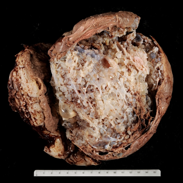 Thai trứng toàn phần (Complete hydatidiform mole)