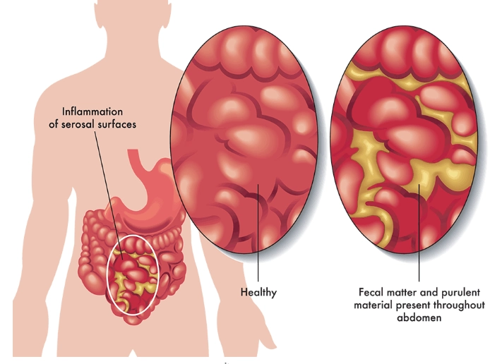 Viêm phúc mạc (Peritonitis)