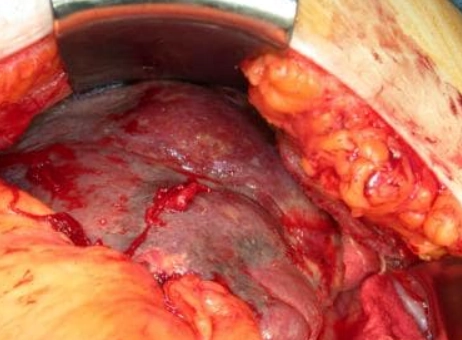 Áp xe lách (Splenic abscess)