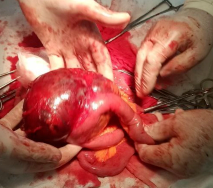 U cơ trơn ruột non (Small bowel leiomyoma)