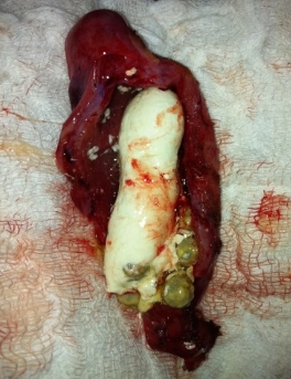 Lắng đọng sữa canxi ở túi mật (Milk of calcium gallbladder)/ Dịch mật vôi (Limy Bile)