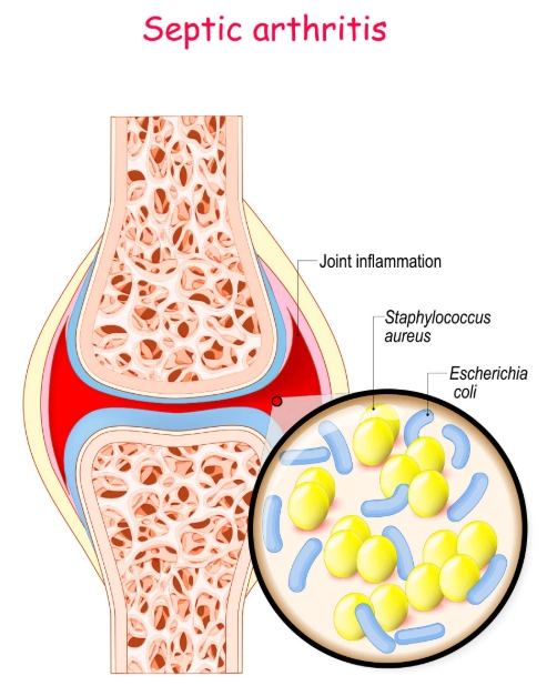 Viêm khớp nhiễm trùng (Septic arthritis)