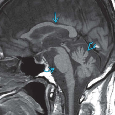 Run/mất điều hòa liên quan đến fragile x (Fragile X-Associated Tremor/Ataxia  - FXTAS) 