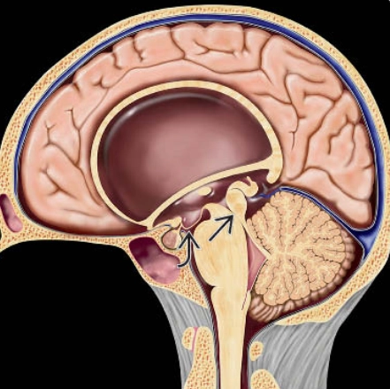 Hẹp cống não (Aqueductal Stenosis)