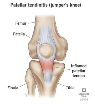 Bệnh lý gối do nhảy (Jumper's knee)