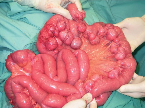 Túi thừa hỗng - hồi tràng (Jejunoileal diverticulitis)