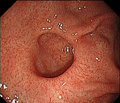 Túi thừa dạ dày (Gastric Diverticulum)