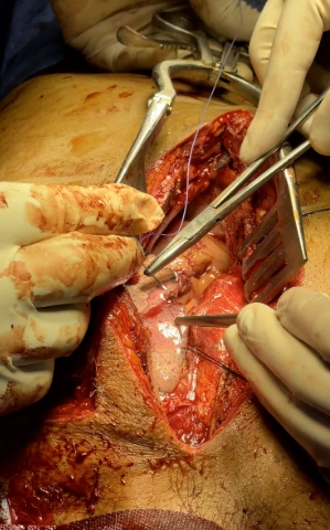 Rách phổi (Pulmonary laceration)