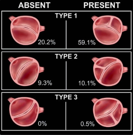 Van động mạch chủ hai lá van (Bicuspid Aortic Valve - BAV)