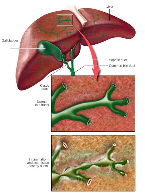 Viêm xơ đường mật nguyên phát (Primary Sclerosing Cholangitis - PSC)