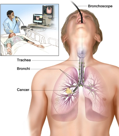 Rách khí phế quản (Tracheobronchial Laceration)