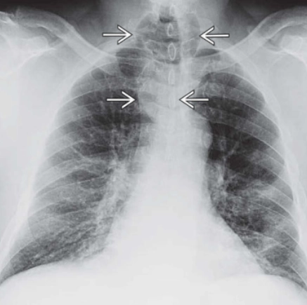 Nhuyễn khí quản (Tracheomalacia) 