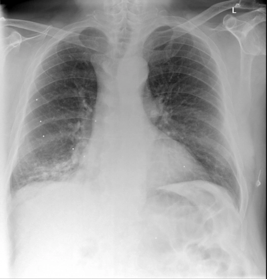 U mô thừa khí phế quản (Tracheobronchial Hamartoma)