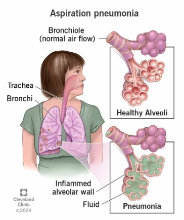 Viêm phổi do hít sặc (Aspiration pneumonia)