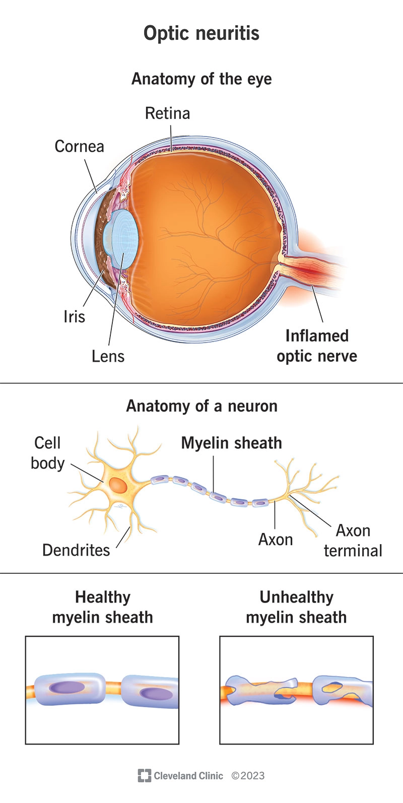 Viêm dây thần kinh thị (Optic neuritis)