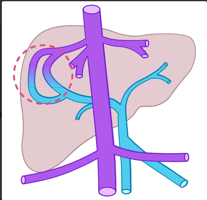 SHUNT CỬA-CHỦ (PORTOSYSTEMIC SHUNT)