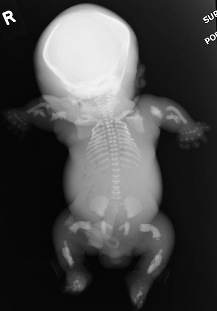 Loạn sản xương quý I (Skeletal dysplasias)