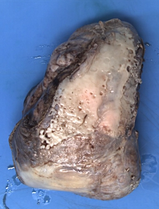 U xơ khu trú của màng phổi (Localized Fibrous Tumor of the Pleura - LFTP)