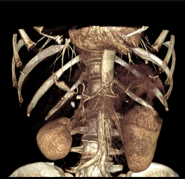 Phình động mạch gan (Hepatic Artery Aneurysm - HAA)