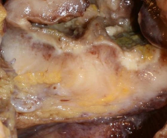 Lymphoma ruột non (Small bowel lymphoma)