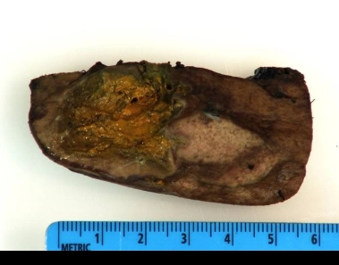 Giãn mạch xuất huyết di truyền (Hereditary Hemorrhagic Telangiectasia - HHT)