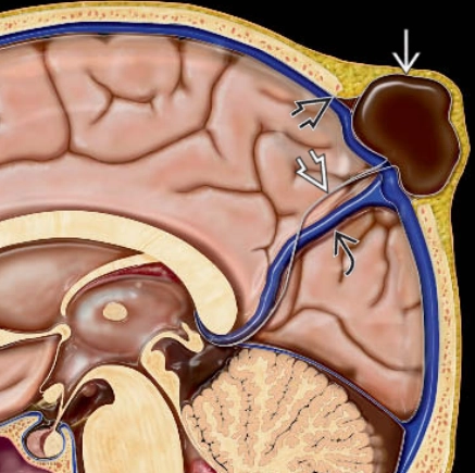 Thoát vị não-màng não đỉnh dạng thoái triển (Atretic parietal cephaloceles)
