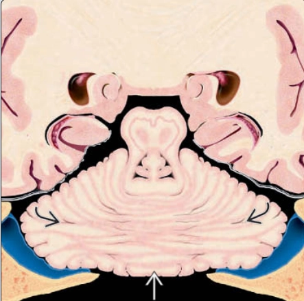 Tật dính trám não thai nhi (Rhombencephalosynapsis)