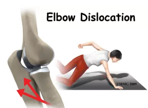 Trật khớp khuỷu (Elbow Dislocation)