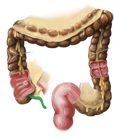 Viêm ruột thừa dưới gan (Subhepatic appendicitis)
