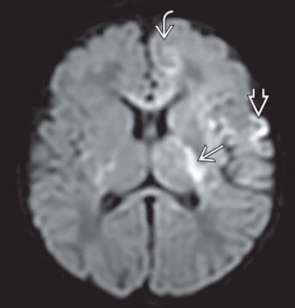 Viêm não do Herpes simplex sơ sinh (Neonatal herpes simplex encephalitis) 