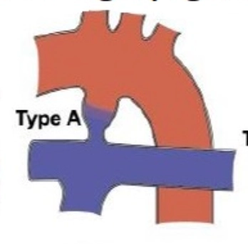Co thắt ống động mạch