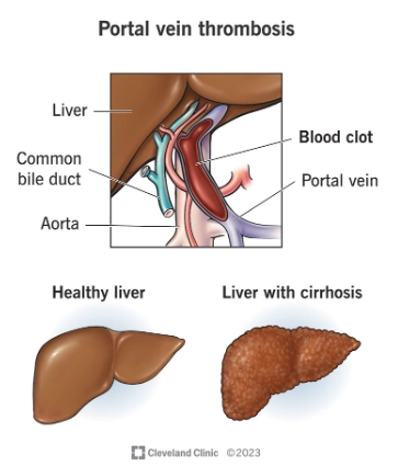 Huyết khối tĩnh mạch cửa (Portal vein thrombosis - PVT)