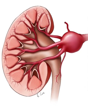 Phình động mạch thận (Renal Artery Aneurysm - RAA)