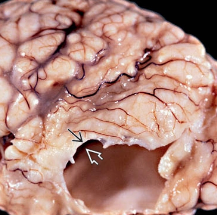 Nang lỗ não (Porencephaly)