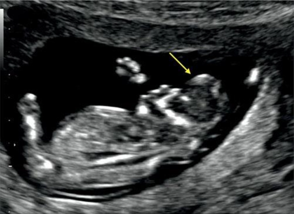 Thai vô sọ (Acrania, Exencephaly và Anencephaly)