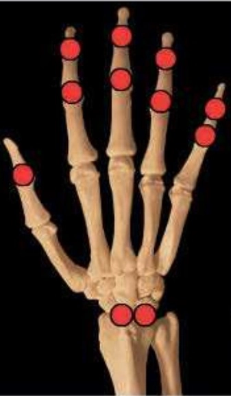 Viêm khớp (Arthritis)