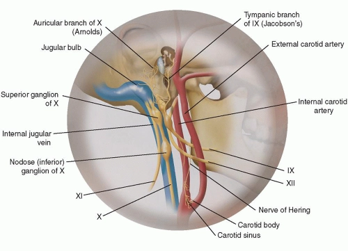 U cận hạch dây thần kinh lang thang (Vagal paraganglioma)