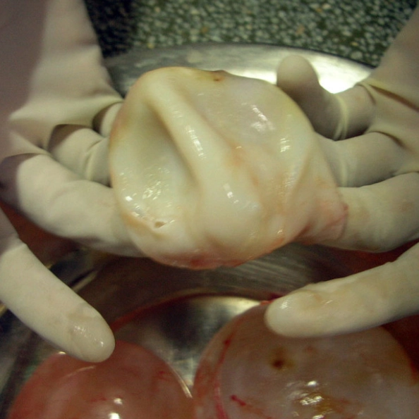 Bệnh nang sán gan (Hepatic hydatid infection)