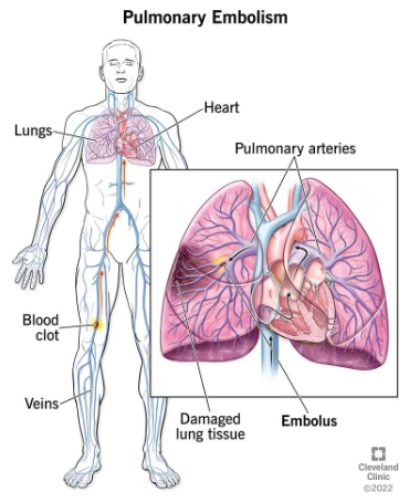 Bệnh lý thuyên tắc huyết khối động mạch phổi cấp (Acute Pulmonary Thromboembolic Disease)