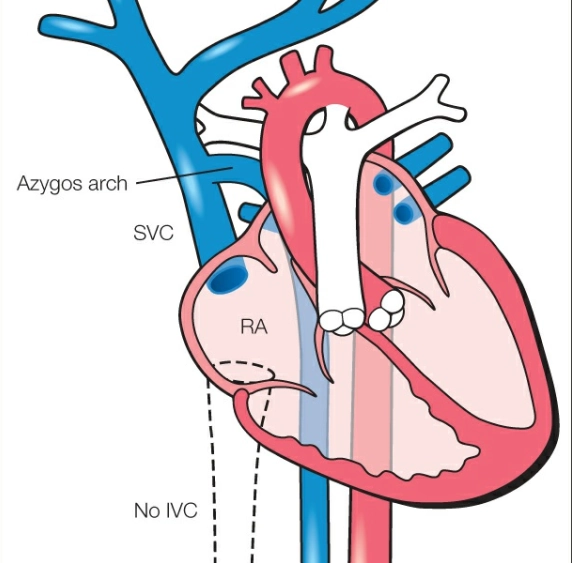 Gián đoạn tĩnh mạch chủ dưới và tiếp nối với tĩnh mạch đơn (Azygos)