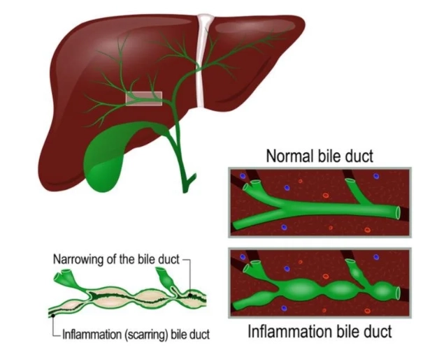Bệnh Caroli và Hội chứng Caroli (Caroli disease)