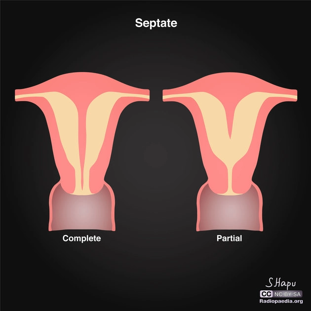 Tử cung có vách ngăn (Septate uterus)