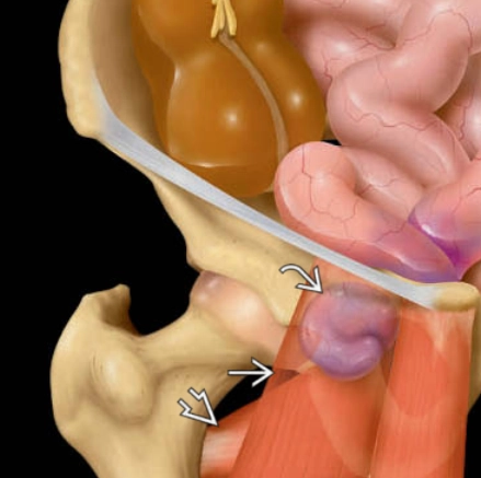 Thoát vị bịt (Obturator Hernia)