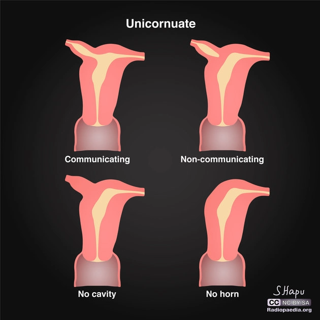 Tử cung một sừng (Unicornuate uterus)