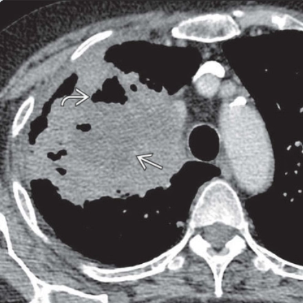 Hang phổi (Pulmonary cavity)