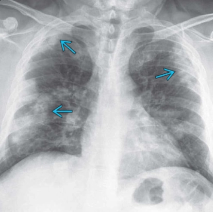 Viêm phổi do nấm Paracoccidioidomycosis