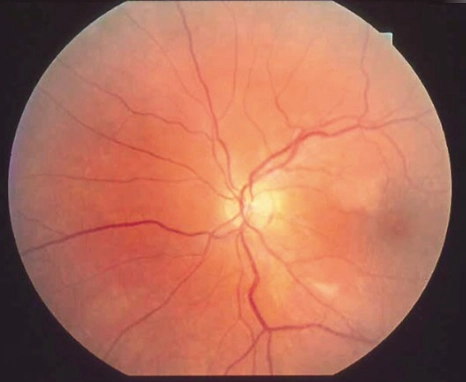 Hội chứng Susac (Susac Syndrome)