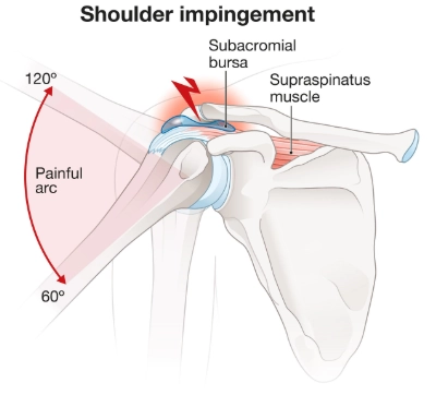 Hội chứng chèn ép dưới mỏm cùng vai (Subacromial impingement)